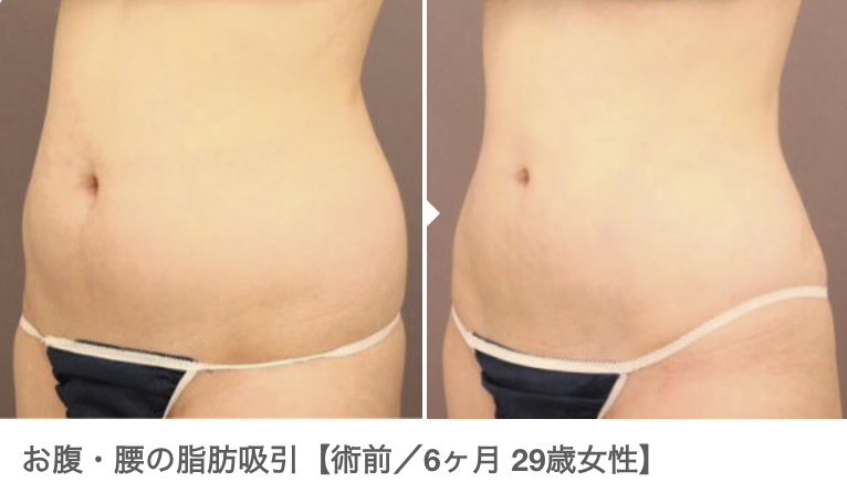 腹部の脂肪吸引施術前後の比較写真。左側は施術前、右側は施術後6ヶ月の状態を示している。