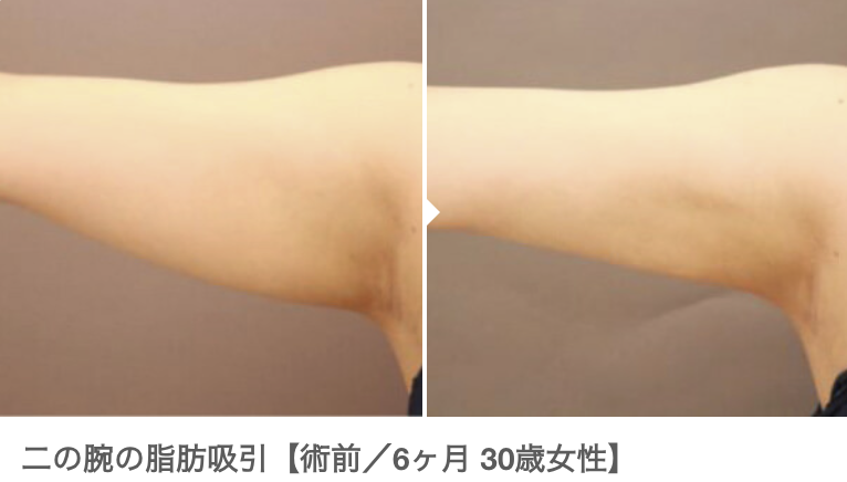 二の腕の脂肪吸引の施術前後を比較した写真。左側は施術前、右側は施術から6ヶ月経過した結果。